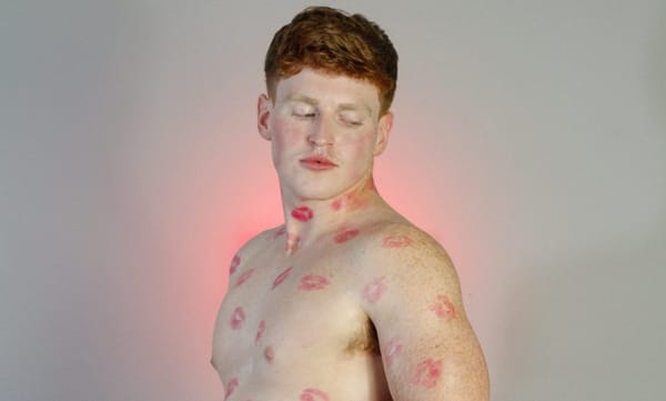 ManCrush: Freckle Fever